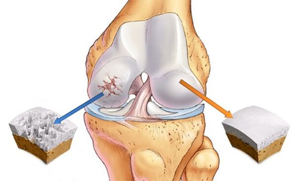 cartilage sain et cartilage affecté par l'arthrose