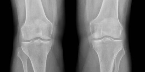 arthrose du genou à la radiographie